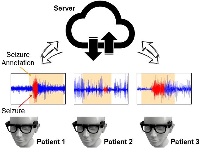 Overview of the federated learning scenario for patient-annotated EEG seizure detection.