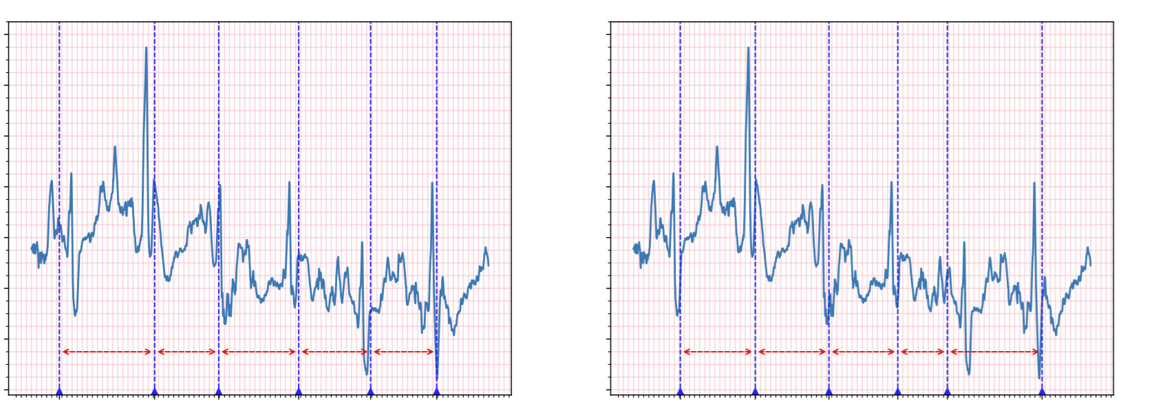 RR Interval Computation Based on Pan and Tompkins and Two Moving Average Algorithms for Noisy Signals